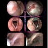 L’endoscopia ad alta definizione con Narrow Band Imaging nel trattamento delle neoplasie delle VADS