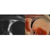 Resnick Course X: MRI of the Joints. Update on Shoulder, Elbow, Wrist, Hip and Ankle