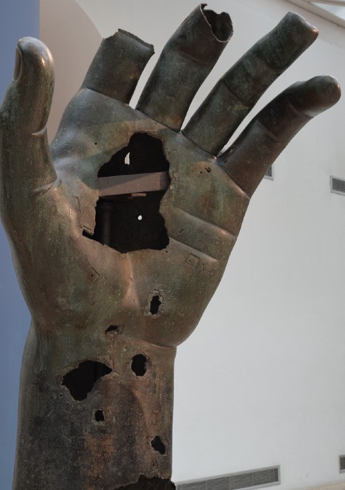 L'artrosi trapezio-metacarpale oggi: diagnosi, trattamento, linee-guida