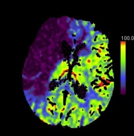 Nuovi orientamenti della diagnosi e terapia dell'ischemia cerebrale in fase acuta