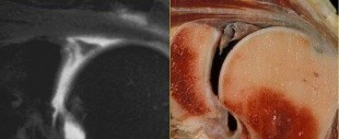 Resnick Course X: MRI of the Joints. Update on Shoulder, Elbow, Wrist, Hip and Ankle